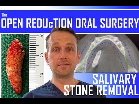 Riesiger Speichelstein | Sialolith-Entfernung | Oralchirurgie