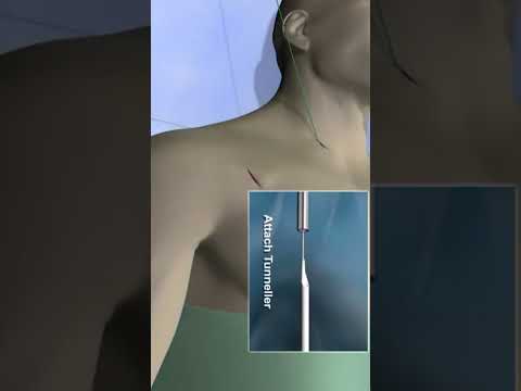 Inserting Dialysis Catheter #dialysis #shorts