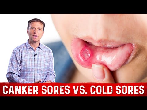 Canker Sores Vs Cold Sores – Dr. Berg on Mouth Sores