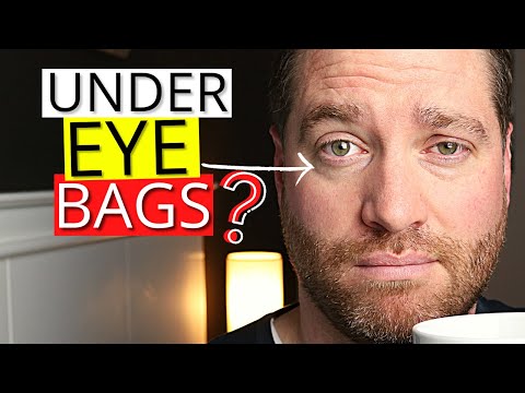 Dark Under EYE BAGS!? - Eye Doc Explains Causes And Treatments For Dark Circle Under Eye Bags!
