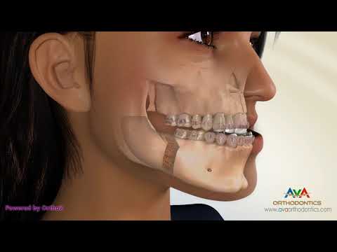 Surgical Orthodontic Treatment for Underbite or Crossbite - Transcortical Mandibular Setback