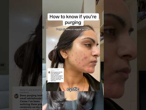 How to know if you’re purging on Accutane #skincare #acne #accutane #dermatology #skincareroutine