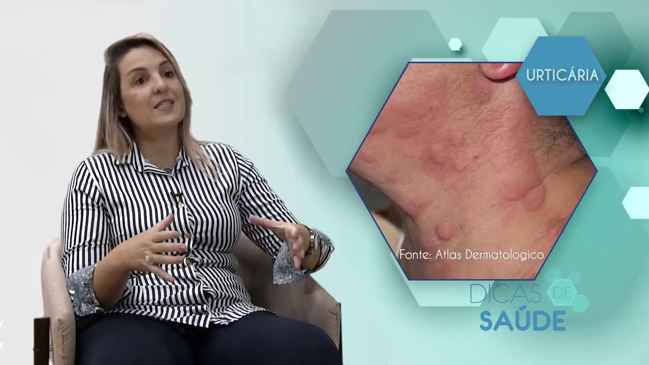 URTICÁRIA | Dicas de Saúde: Dra. Fernanda Caldeira