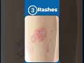 5 Signs Of Autoimmune Disease Rheumatoidarthritis Lupus Psoriaticarthritis Autoimmunedisease