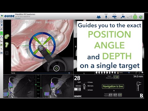 Introduction to the X-Guide Dynamic 3D Navigation System
