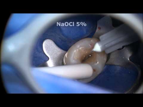 Endodontic Access and Root Canal Preparation explained