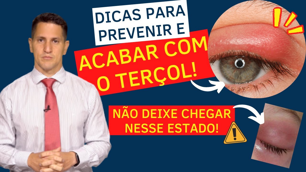 DICAS PARA SE LIVRAR DO TERÇOL! | Dr. Arthur Farache