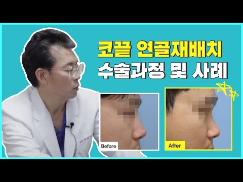 코끝연골재배치 안내 영상