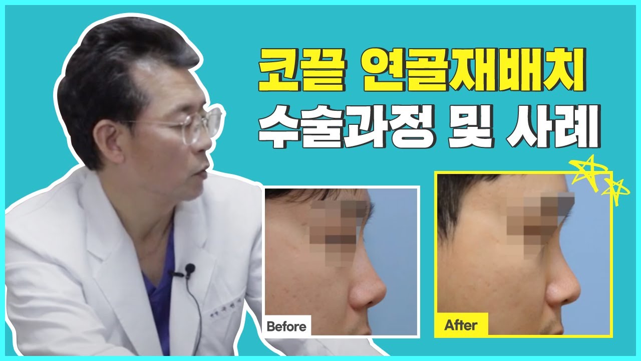 코끝연골재배치 안내 영상 썸네일