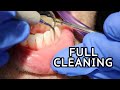 How Teeth Are Cleaned At The Dentist
