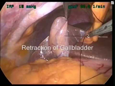 Single Incision Laproscopic Surgery