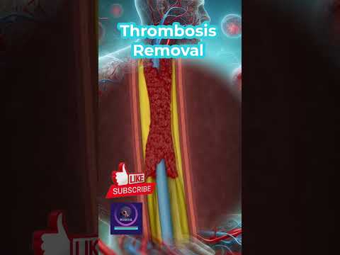 Thrombosis Removal Procedure | 3D Animation