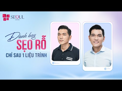 Điều Trị Sẹo Rỗ Hiệu Quả Chỉ Sau 1 Liệu Trình