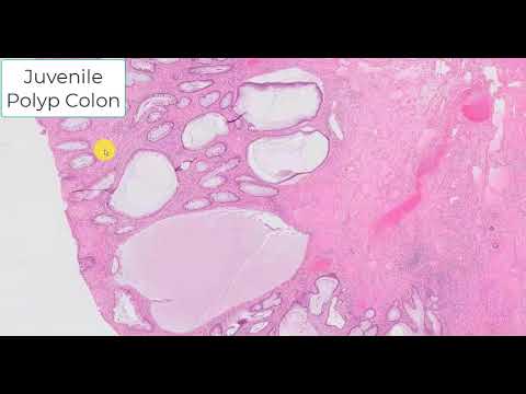 Juvenile polyp colon - sporadic type