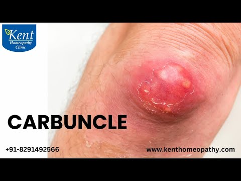 Carbuncle-homeopathy treatment #drkukrejakalani #kenthomeopathyclinic #onlineconsultations