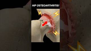 Doctor Explains: Hip OSTEOARTHRITIS 🦴💢