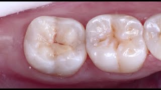 Chairside Live Episode 218: Camouflaging a Caries Cleanout