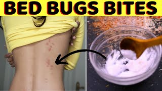 Easy way to get rid of bed bug bites overnight and fsat on your body skin in one day   home remedy