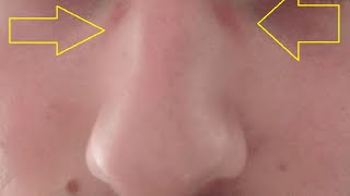 how to get rid of glasses mark under eyes