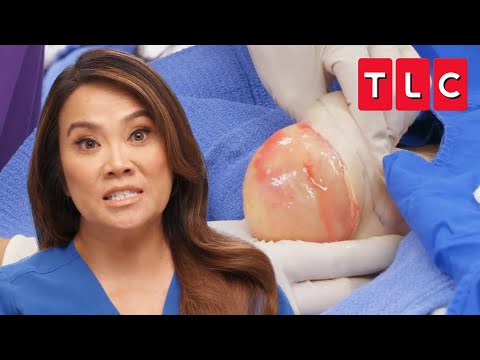 All the Pops from Season 7 | Dr. Pimple Popper | TLC