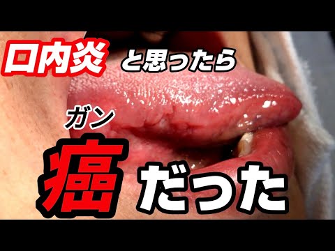 ショー優勝者、稀な腫瘍の診断を説明「口内炎だと思った」