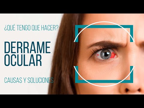 DERRAME EN EL OJO ¿Qué tengo que hacer?