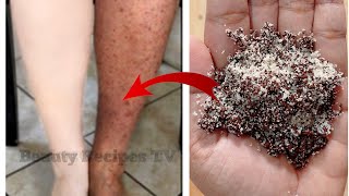 How to remove mosquito bite marks on legs, get rid of Dark spots, Mosquito Bites, Hyperpigmentation
