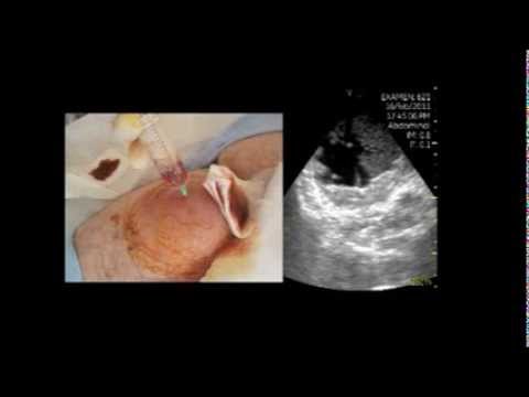 Abscess In The Femoral Region