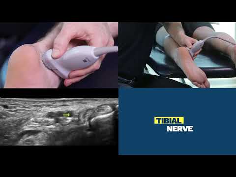 How to Scan & Inject a Tibial Nerve with Ultrasound