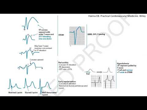 ST elevation on ECG, part 1: Differential diagnosis and case studies- STEMI mimickers, subtle STEMI