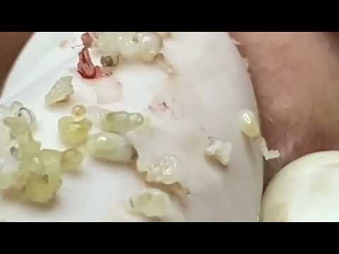 Extra Large Blackheads