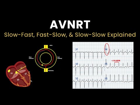 AVNRT Explained: Fast-Slow, Slow-Fast, and Slow-Slow ECG Patterns