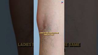 Download lagu Varicose Veins or Reticular Veins? #shortfeed #veinspecialist #spiderveins mp3
