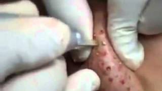 Extreme Acne Treatment, Laser and Pus Fly Widely