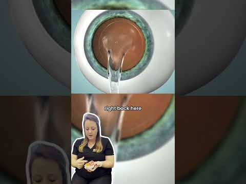 EVO ICL - Implantable Contact Lens