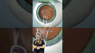 EVO ICL - Implantable Contact Lens