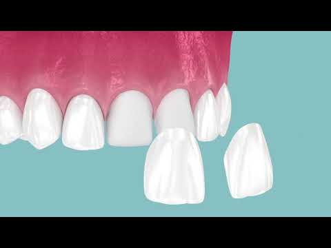 Porcelain Veneers — video thumbnail