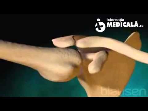 Artroza deformantă a articulației șoldului stâng