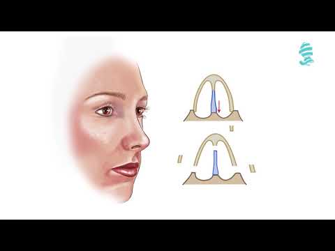 Rhinoplasty: Detailed animation about the operation