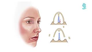 Rhinoplasty: Detailed animation about the operation