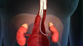 Viserial Stents Animation
