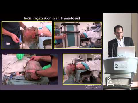 Awake vs Asleep DBS for Movement Disorders by Francisco Ponce, MD