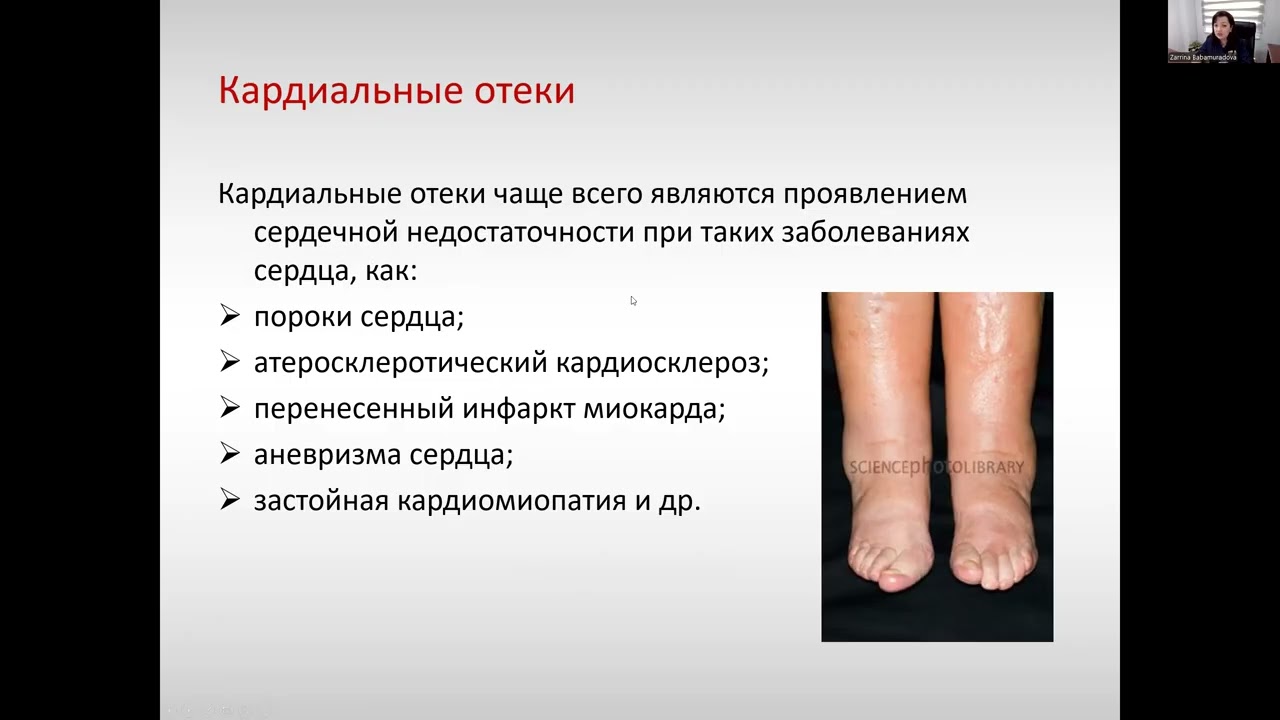 Дифференциальная диагностика при отечном синдроме