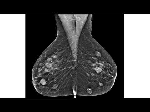 Múltiplos nódulos com morfologia de BI-RADS 3 na mamografia. Como classificá-los?