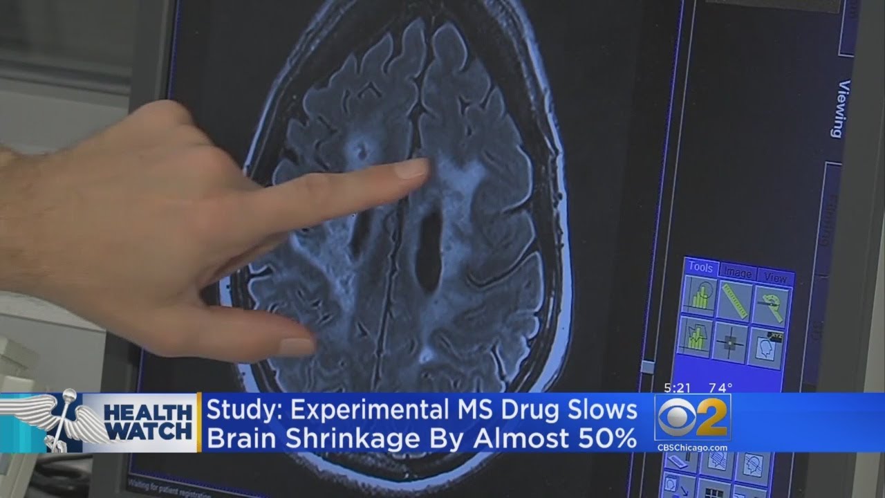 New Drug Shows Promise For Patients With Progressive Multiple Sclerosis