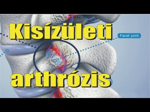 Osteoarthrosis artrózis térd gonarthrosis