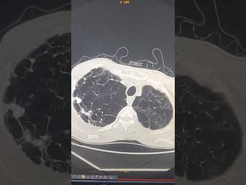 Emphysème pulmonaire.
