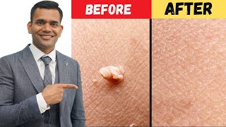 Remove Skin Tags and Warts Within 24 Hours - Dr.Vivek Joshi