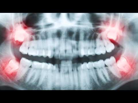Impacted Teeth | Abnormalities in Tooth Quantity- 2