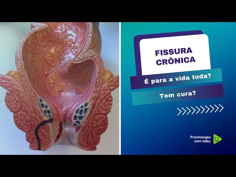 Fissura anal crônica tem cura? - Dr. Marcelo Werneck